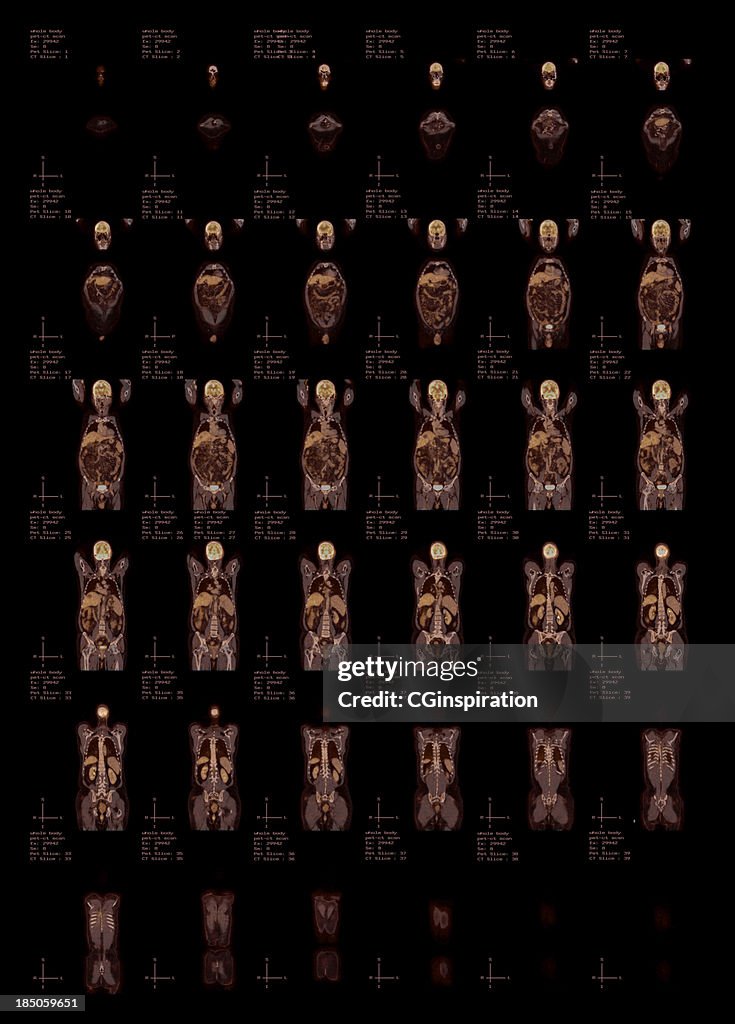 Whole Body Pet-CT Scan Top View