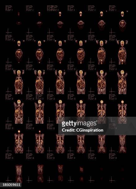 whole body pet-ct scan top view - mri abdomen stock pictures, royalty-free photos & images