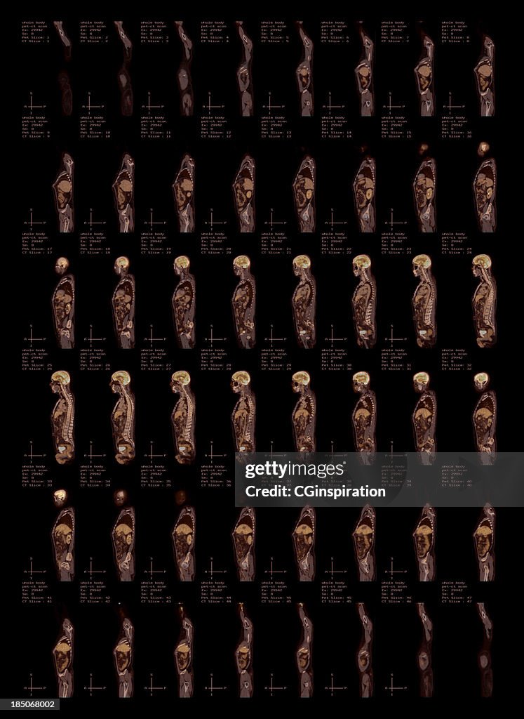 Whole Body Pet-CT Scan Side View