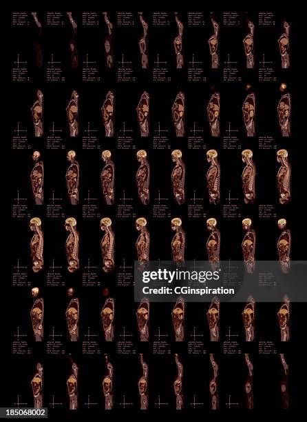 whole body pet-ct scan side view - gamma scanning machine stock pictures, royalty-free photos & images