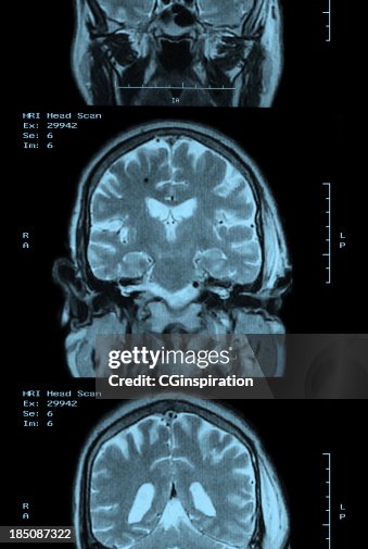Mri Film Examples Mri Scan Film Strip High-Res Stock Photo - Getty Images