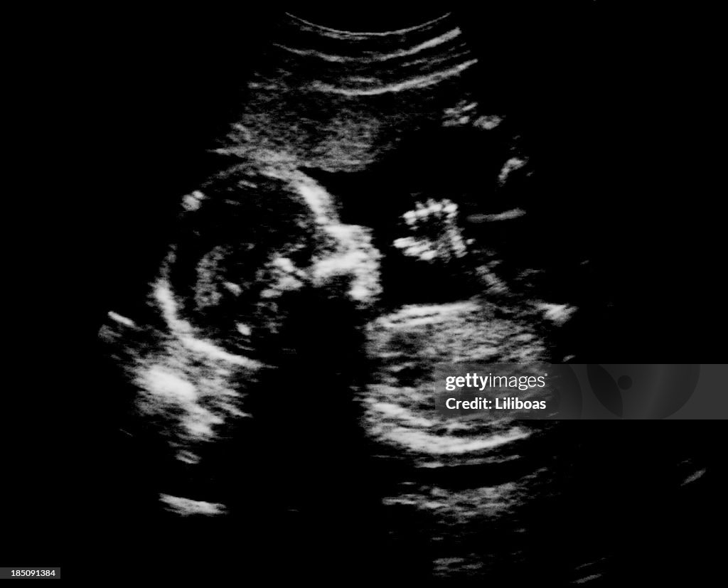 Ultrasound scan of fetus's head, hand and fingers