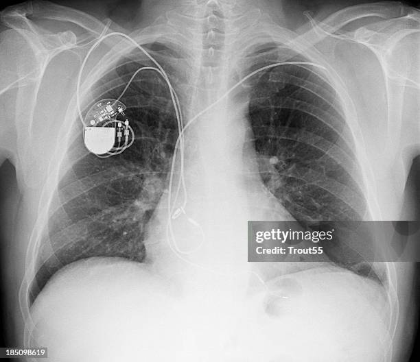 x-ray picture - chest with pacemaker - a v pacemaker stock pictures, royalty-free photos & images