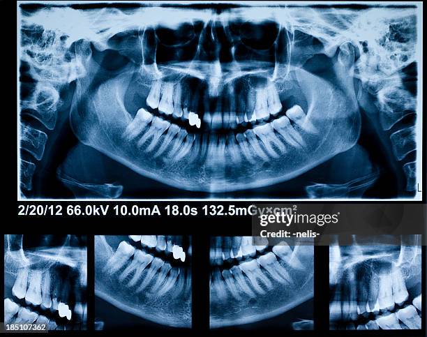 panoramic dental x-ray - rotten teeth from not brushing stockfoto's en -beelden