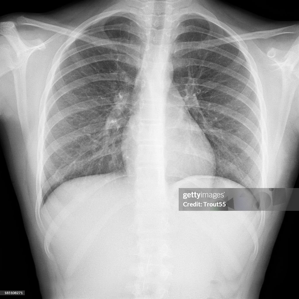 Xray Picture Chest High Res Stock Photo Getty Images xray-picture-chest-high-res-stock-photo-getty-images