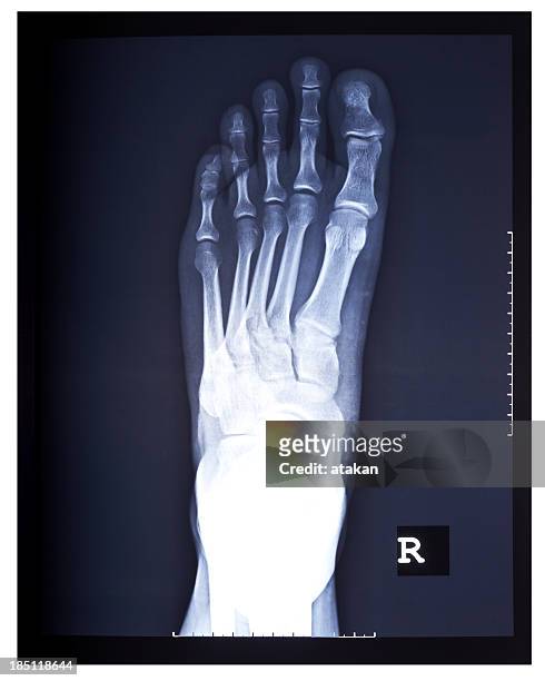 foot x-ray image - human foot anatomy stock pictures, royalty-free photos & images