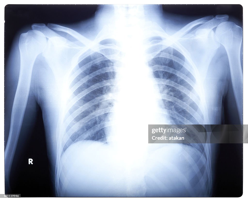 Chest X-ray image