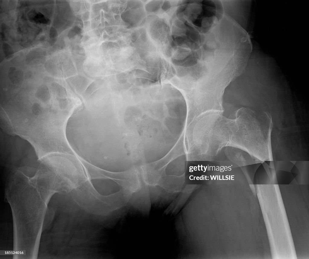 Pelvic xray showing a fractured left femur