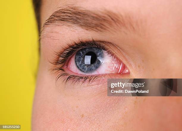 a close-up of blue eye that is bloodshot - bloodshot eye stock pictures, royalty-free photos & images