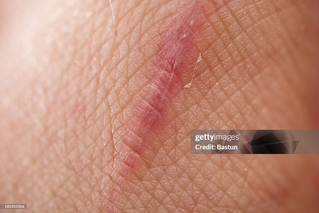 Close up scar on skin