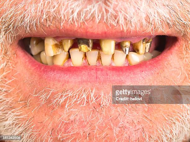 bad teeth - tooth cap stock pictures, royalty-free photos & images