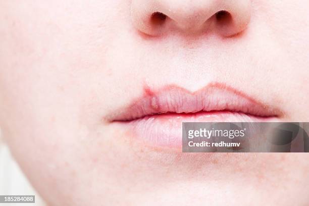 herpes cold sore on mouth - blister stock pictures, royalty-free photos & images