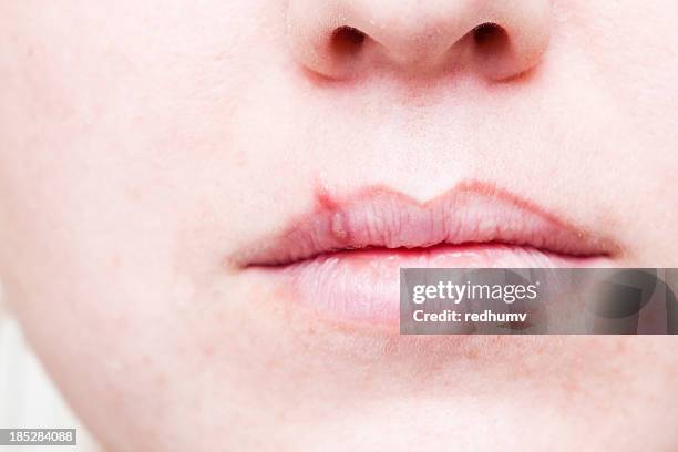 herpes herpes labial na boca - herpes labial - fotografias e filmes do acervo