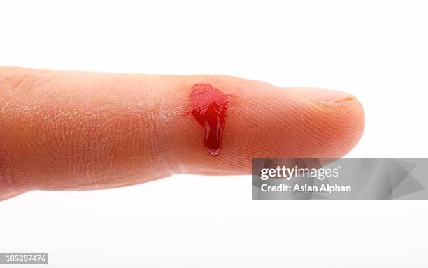 injured finger - hand laceration stockfoto's en -beelden