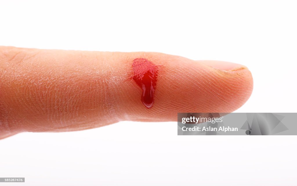 Injured finger