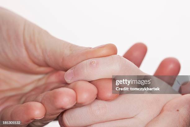 an adult holds the hand of a child with a macro wart - wart stock pictures, royalty-free photos & images