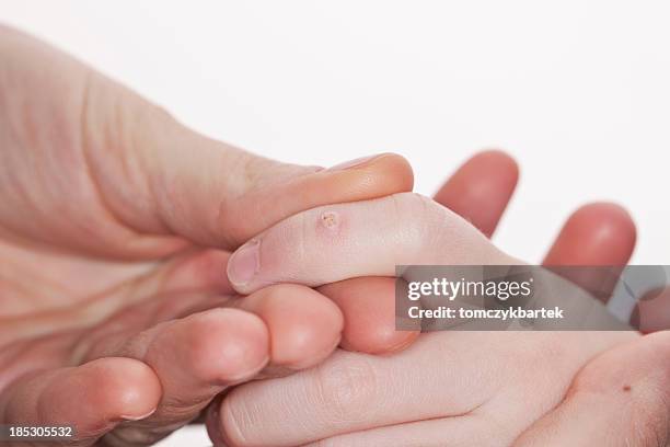 an adult holds the hand of a child with a macro wart - warts stock pictures, royalty-free photos & images