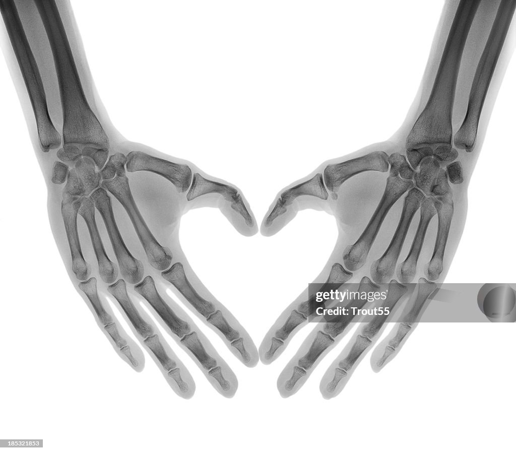 Negative X-ray-menschlichen Palmen in einer Herzform Gefaltet