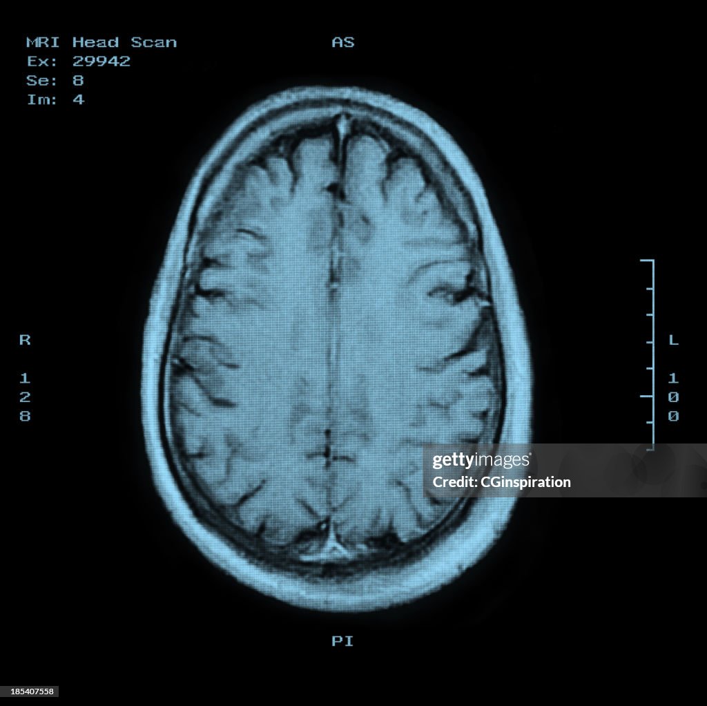 MRI Head Scan Top view