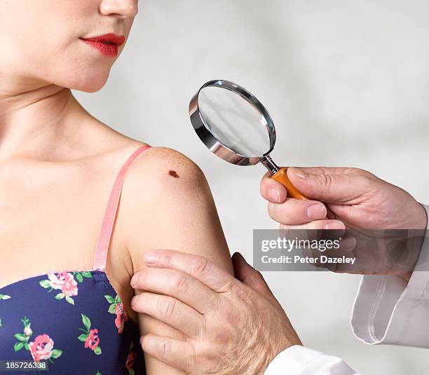 dermatologist inspecting melanoma - mélanome photos et images de collection