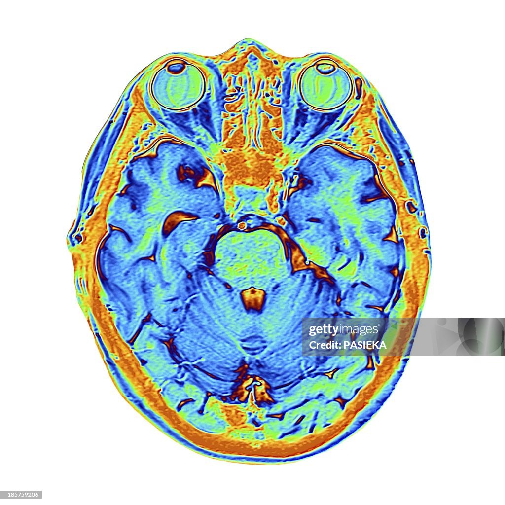 Coloured MRI scan of the human head