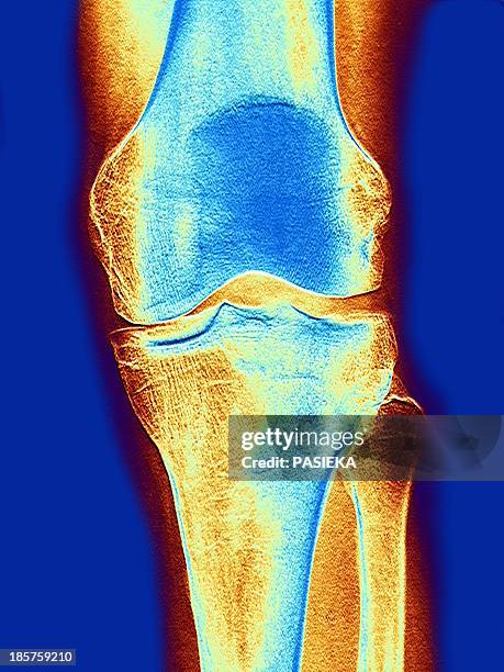 ilustrações, clipart, desenhos animados e ícones de knee joint, x-ray - physiology