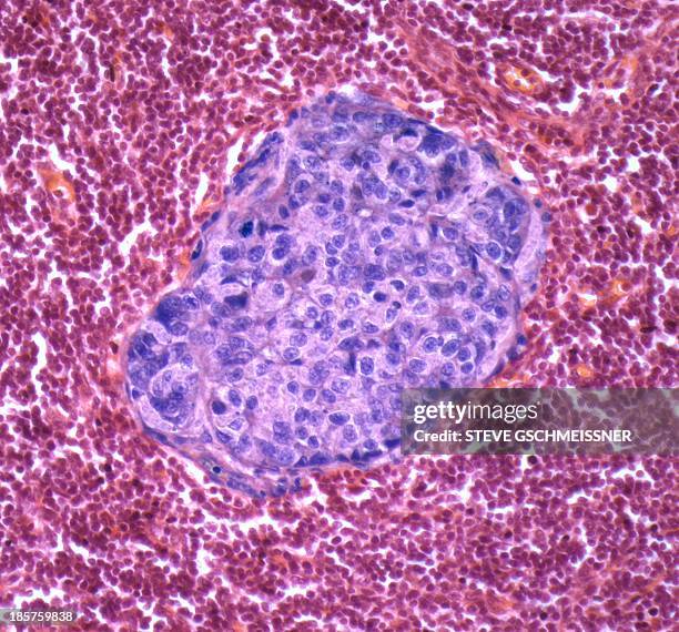 metastatic breast cancer - tumore metastatico foto e immagini stock