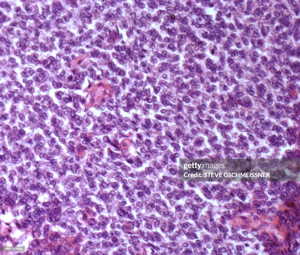 Bone cancer, light micrograph