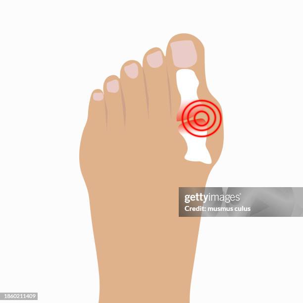 stockillustraties, clipart, cartoons en iconen met deformities of the big toe, hallux valgus - gout