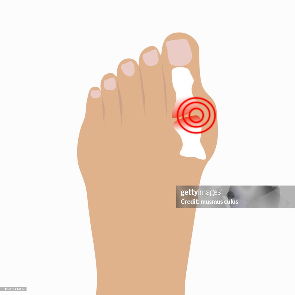 Hi Resolution Toes Deformities Of The Big Toe Hallux Valgus High-Res Vector Graphic ...