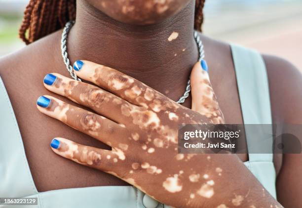 nahaufnahme von händen mit vitiligo auf der haut einer schwarzen frau - vitiligo stock-fotos und bilder
