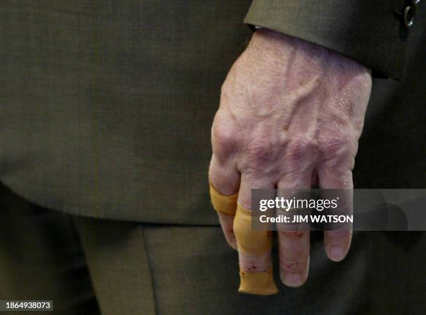 Picture shows US President George W. Bush's bandaged hand during a press conference at the Gleneagles hotel 07 July 2005, during the G8 Summit....