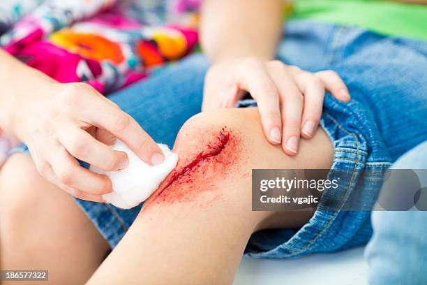 mother cleaning sons wound. - ehbo stockfoto's en -beelden