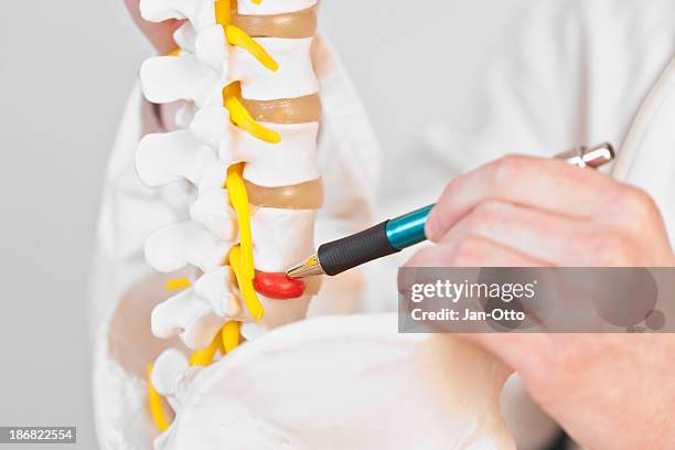 lumbar disc herniation - human vertebra 個照片及圖片檔