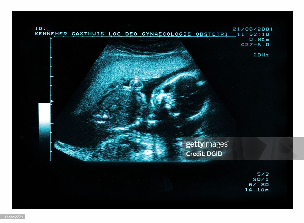 Baby Ultrasound Echo