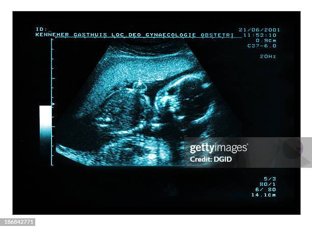 baby ultrasound echo - twin ultrasound stock pictures, royalty-free photos & images