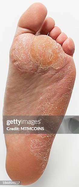 athlete's foot and callus - images of ugly feet stock pictures, royalty-free photos & images