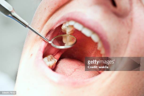 paciente en el dentista con la boca abierta durante el tratamiento en los dientes - plaque bacteria fotografías e imágenes de stock