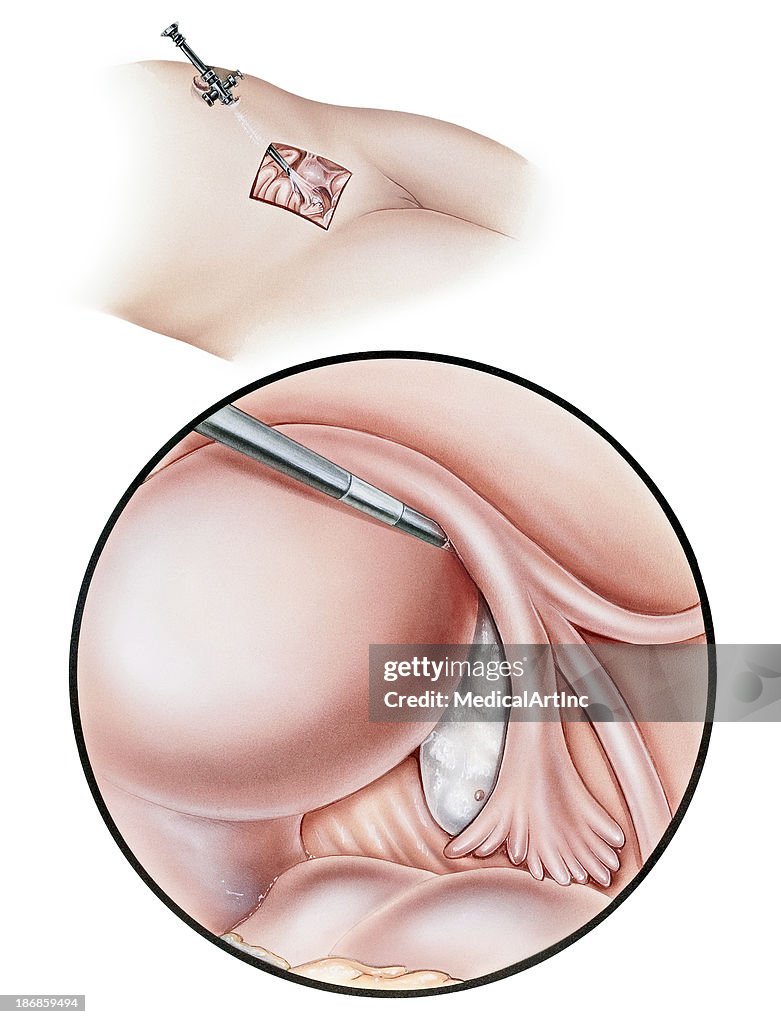 Laparoscopy-Diagnose
