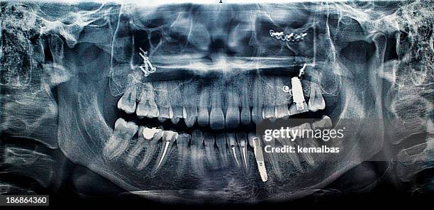 implant - implant stock pictures, royalty-free photos & images