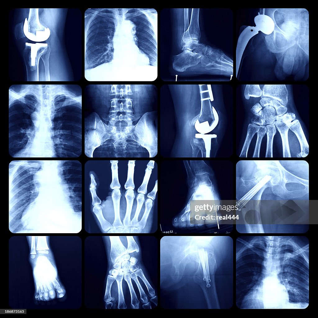 X-ray