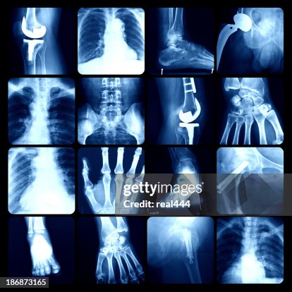 X-ray X-ray