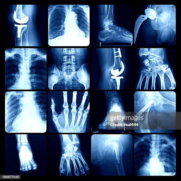 x-ray - costela osso humano - fotografias e filmes do acervo