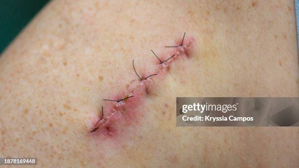 stitches on arm after surgery - biopsy stock pictures, royalty-free photos & images