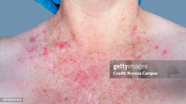 red skin rash with bumps, scabs - psoriasis skin - hautkrankheiten stock-fotos und bilder