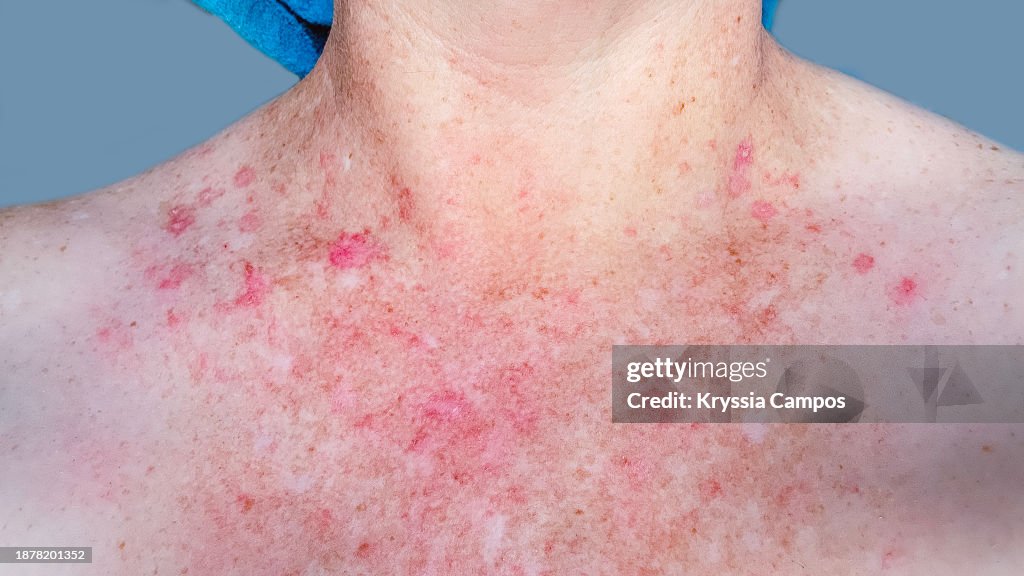 Red Skin Rash With Bumps, Scabs - Psoriasis Skin