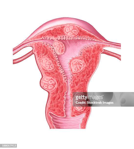 stockillustraties, clipart, cartoons en iconen met anatomy of fibroid tumors in female uterus. - fibroids