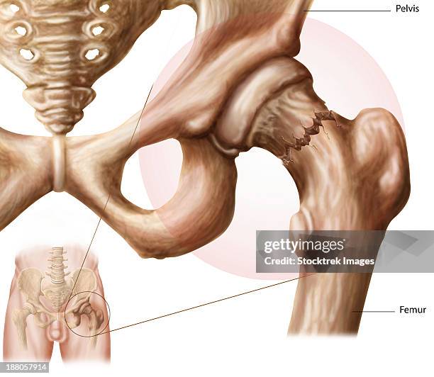 anatomy of hip fracture. - acetabulum stock illustrations
