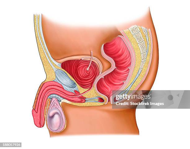 medical illustration of a rectourethral fistula. - cutaway drawing 幅插畫檔、美工圖案、卡通及圖標