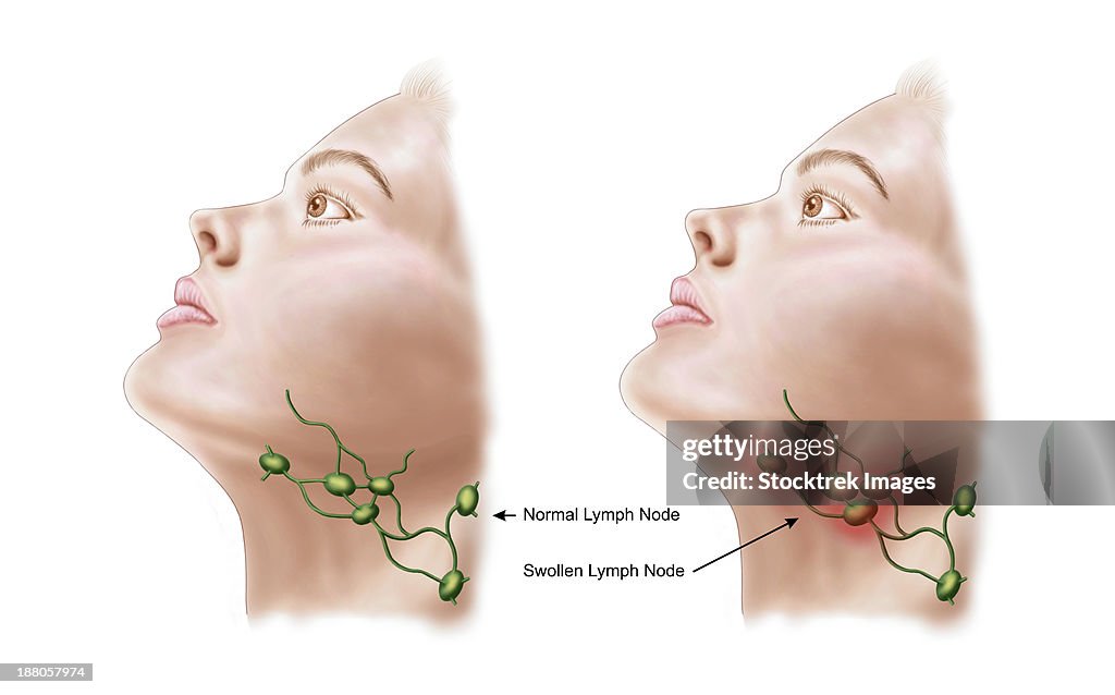 Anatomy of swollen lymph nodes.